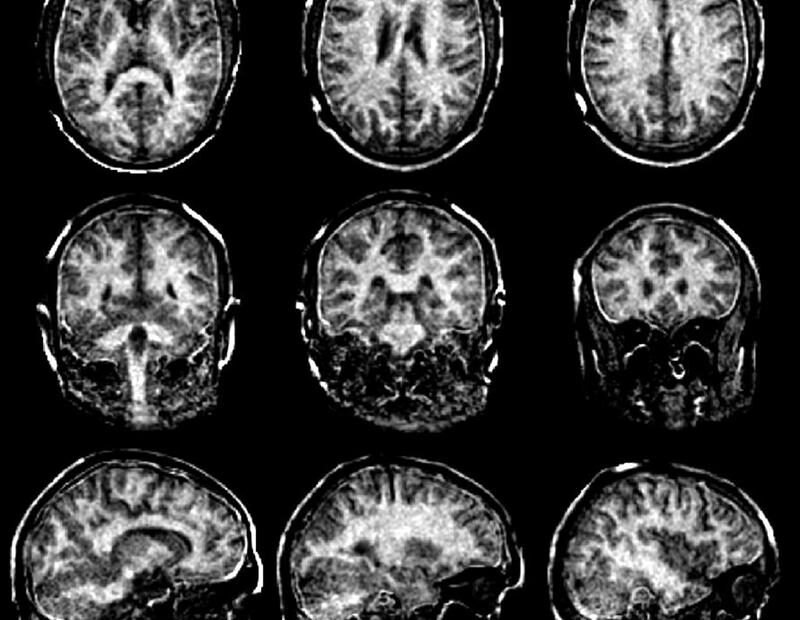 Mit besseren MRT-?Scans der Myelinscheiden im Gehirn soll Multiple Sklerose frühzeitig erkannt werden. | Copyright: ETH Zürich