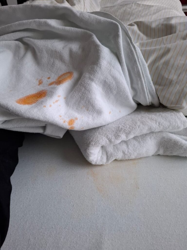 Aus dem OP Saal zu Station 4. Und bis zur Abschiebung in die Reha so belassen: Bettzeug als Infektionsgefahr. Credits: LabNews Media LLC